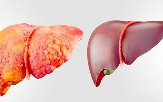 پیشگیری از کبد چرب یک ضرورت در جامعه امروز